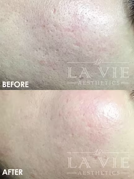 MRF (RF Microneedling) Promotion